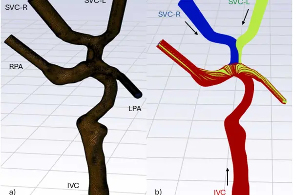 CFD Analysis of Fontan Procedure for Children with Single Ventricle Heart Disease